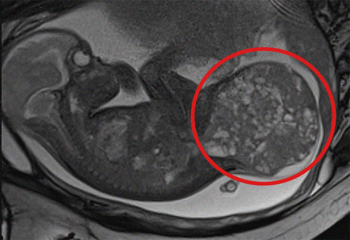 La risonanza magnetica fetale, cerchiata la massa tumorale che occupa la parte inferiore del corpo del feto.