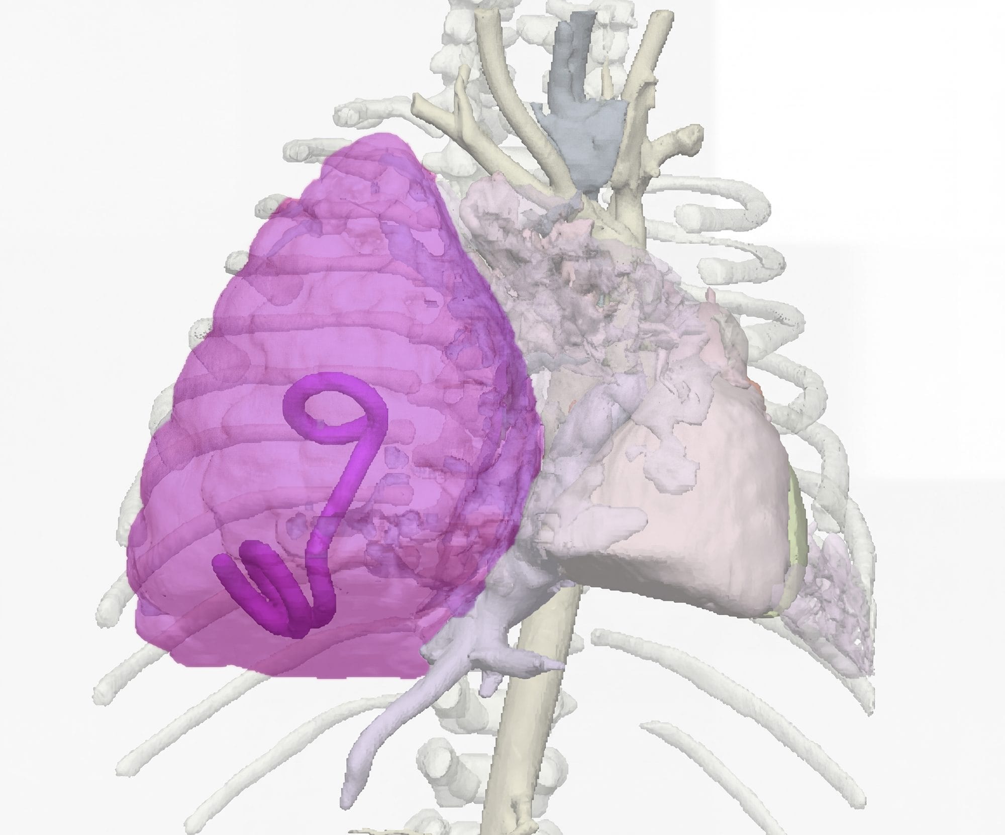 In viola la cisti trovata nel torace del piccolo dagli specialisti del Bambino Gesù