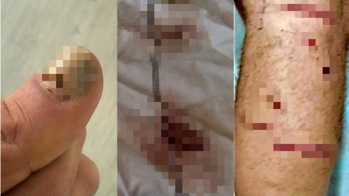 Le ferite dopo le torture. Partendo da sinistra: l’unghia staccata, il lenzuolo macchiato di sangue, i tagli sulla gamba