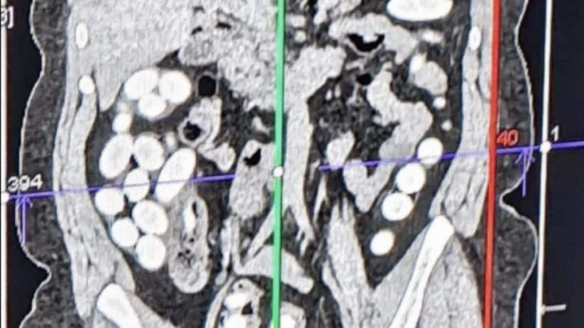 L’ecografia con cui sono stati individuati gli ovuli (da guardia di finanza)