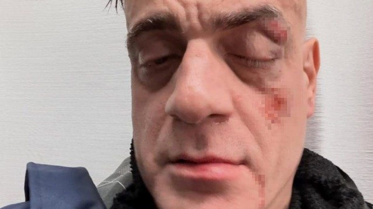 Ruzzi dopo il pestaggio nella metro Ottaviano a Roma (Foto dal profilo Instagram)