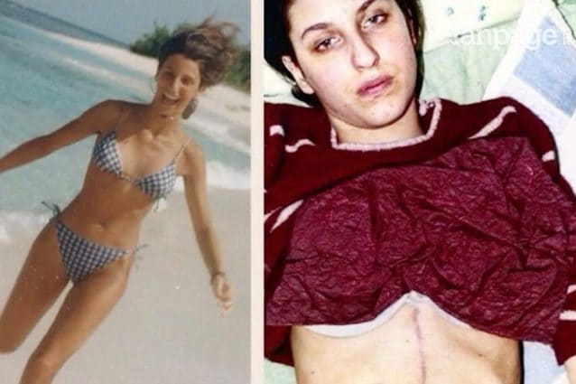 Giorgia Benusiglio prima e dopo la pasticca di ecstasy che ha rischiato di ucciderla