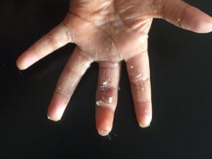 La mano della bimba col dito reimpiantato