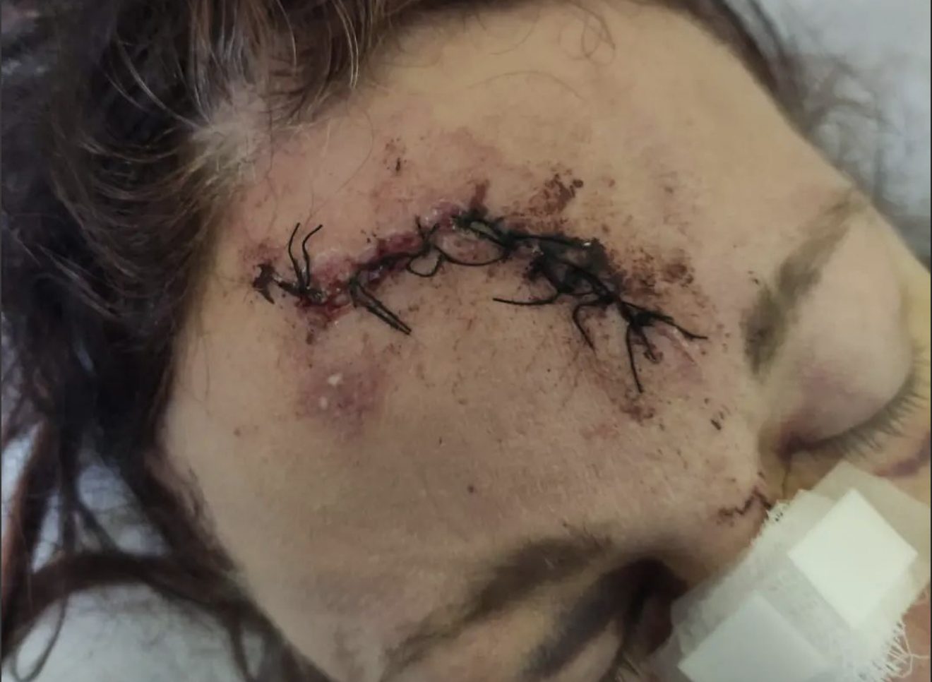 Rione Sanità, investita da scooter sequestrato e senza assicurazione guidato da due ragazzini