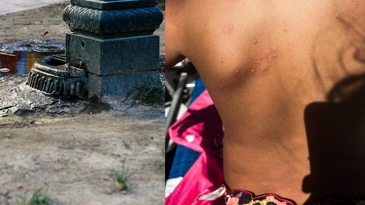 Bolle e irritazioni sul corpo di uno dei bambini che aveva giocato nel parco.