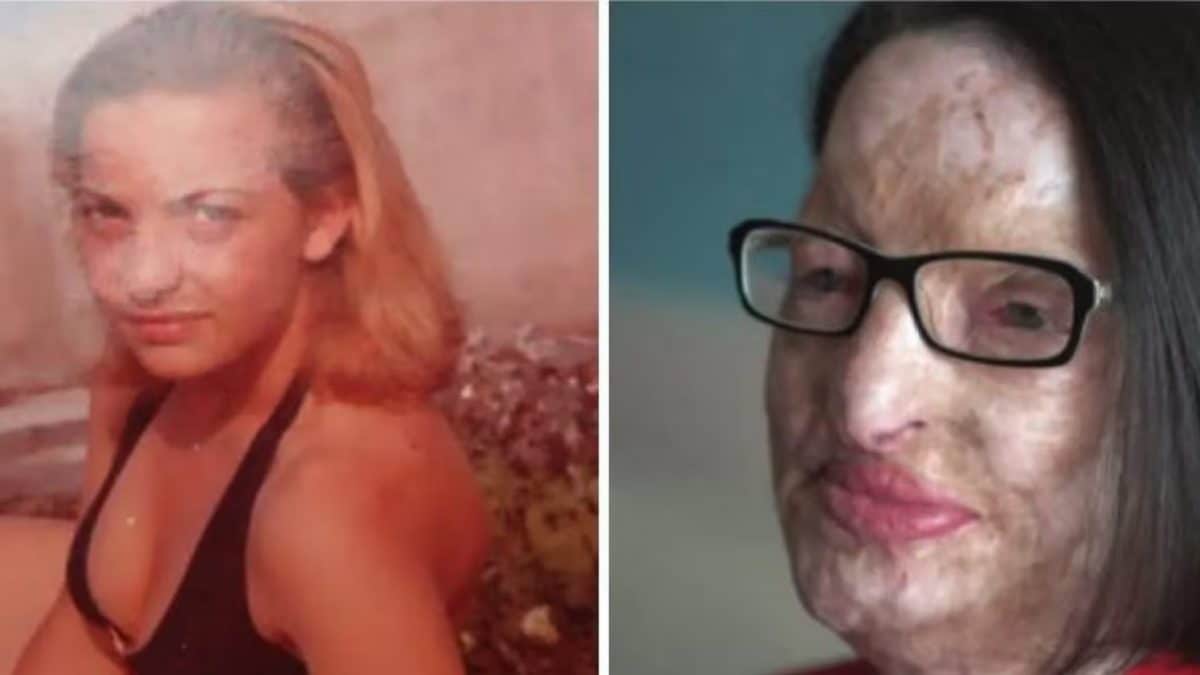Filomena Lamberti, prima e dopo l’aggressione