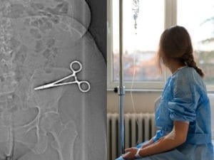Napoli, operata la donna con le forbici dimenticate nella pancia, la figlia: “Mamma soffriva, le dicevano che erano i punti”