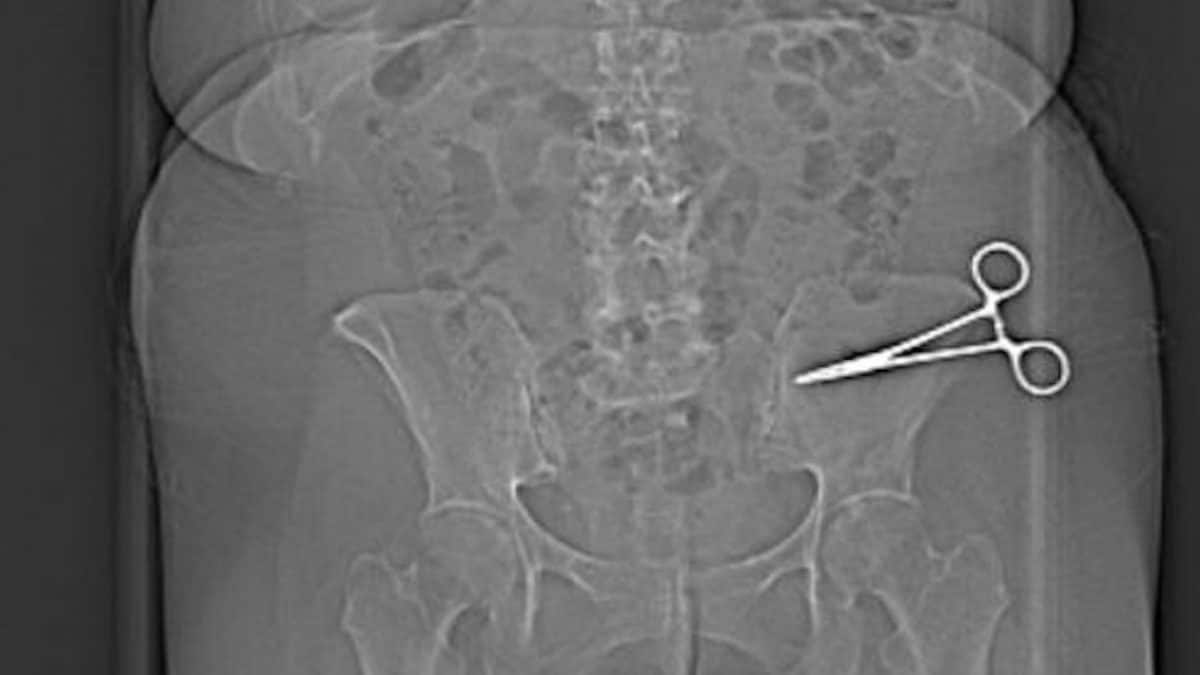 La tac che ha rivelato la presenza delle forbici nell’addome della donna