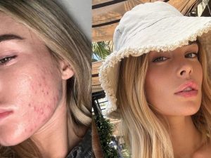 Sophie Codegoni racconta l’esperienza con l’acne: “Non ci rende meno degne d’amore”