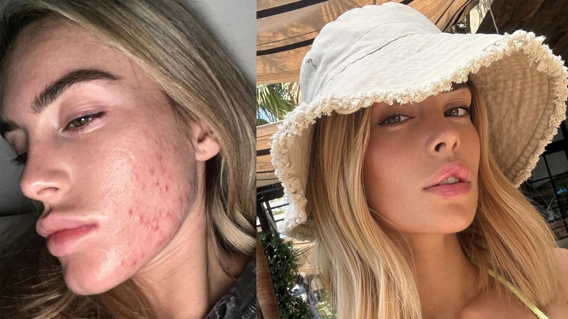 Sophie Codegoni racconta l'esperienza con l'acne: "Non ci rende meno degne d'amore"