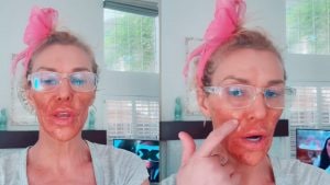 Cosa è successo davvero al viso di Brandi Glanville, la dermatologa: "I parassiti facciali non esistono"