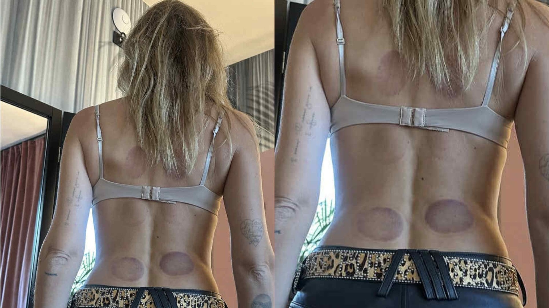 A cosa serve la coppettazione, il nuovo trattamento provato da Chiara Ferragni