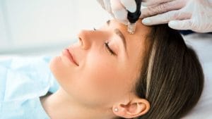Micro- needling, l'esperta "Rende la pelle compatta e luminosa"