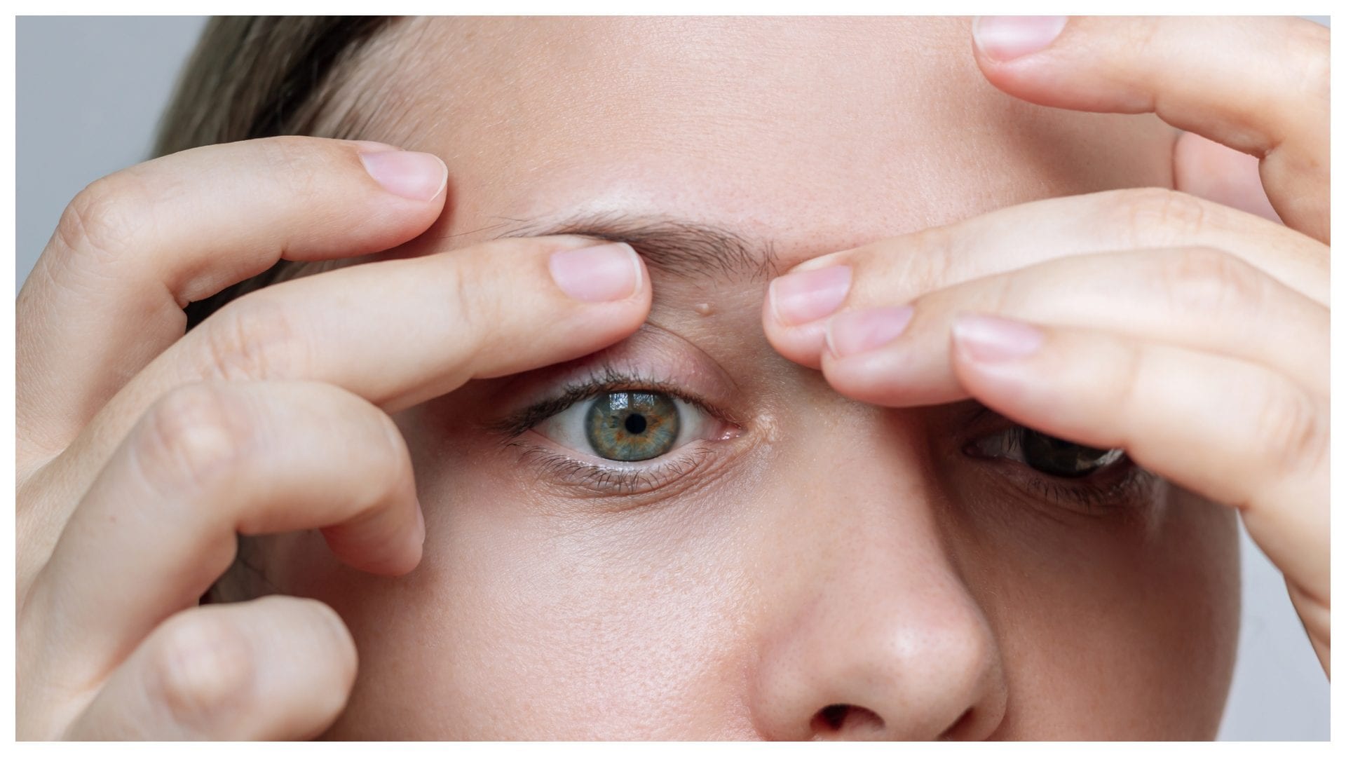 Cosa sono i grani di miglio e come distinguerli dai brufoli, la dermatologa spiega come prevenire la ricomparsa