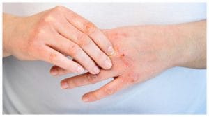 Dermatite atopica, una malattia ancora poco discussa, il dermatologo: "Il 20% dei pazienti soffre di depressione"