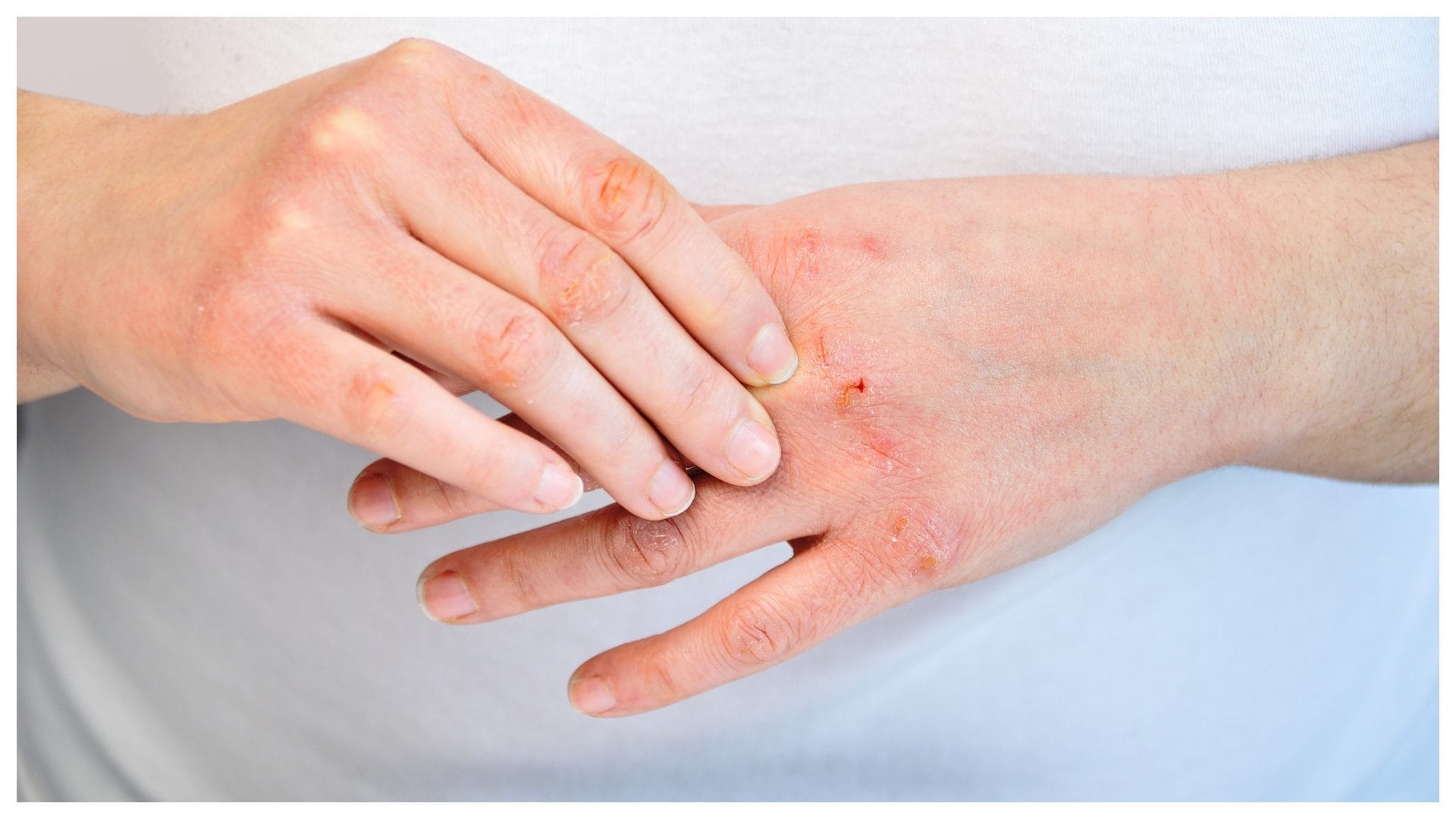 Dermatite atopica, una malattia ancora poco discussa, il dermatologo: "Il 20% dei pazienti soffre di depressione"