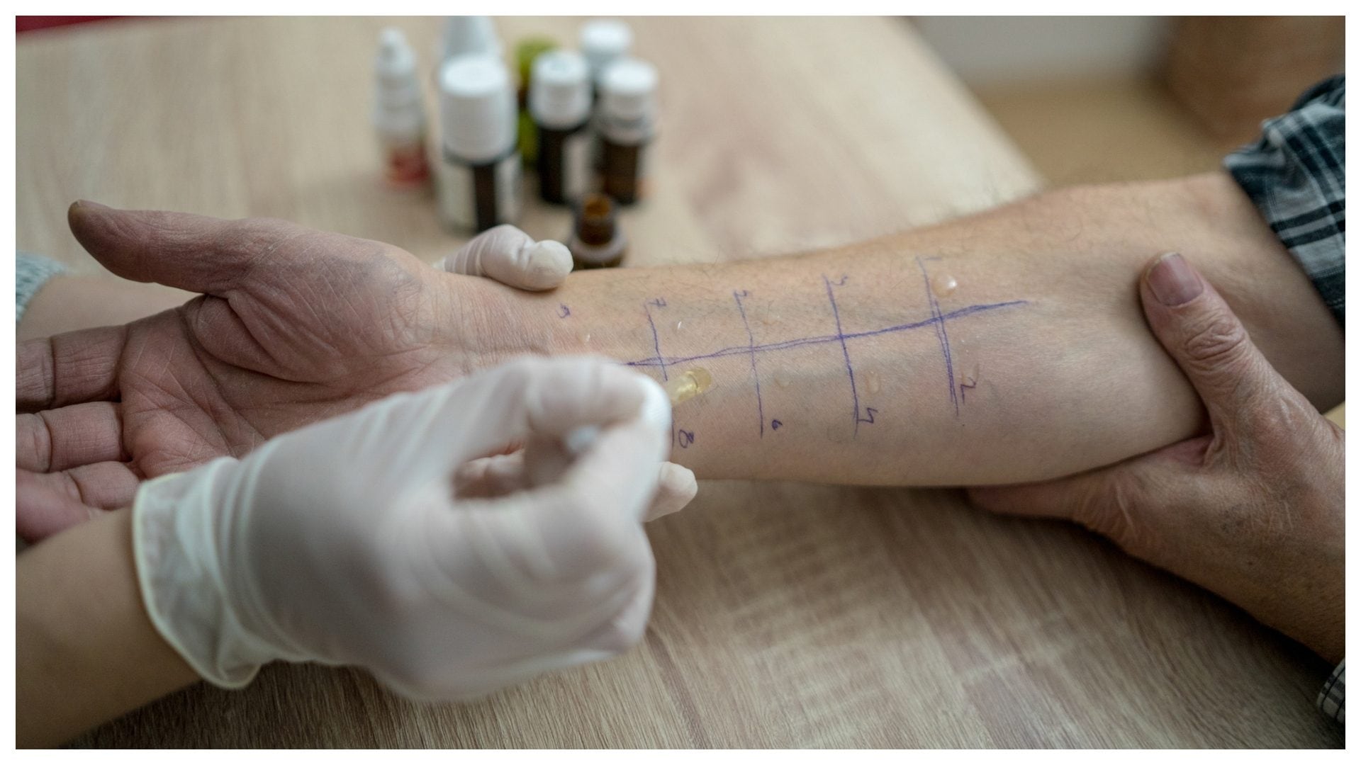 Allergie allo sport o all'acqua, esistono davvero: un allergologo rivela le patologie più strane