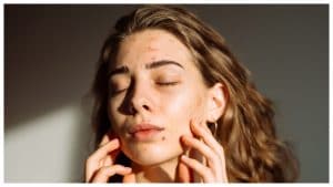 La skincare può peggiorare le infiammazioni da acne: un dermatologo spiega i rischi della beauty routine