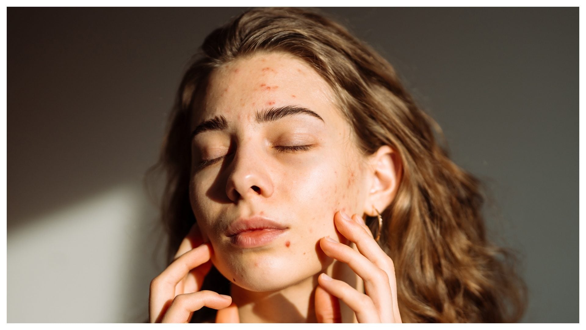 La skincare può peggiorare le infiammazioni da acne: un dermatologo spiega i rischi della beauty routine