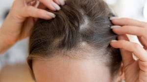 Perdita di capelli nelle donne: la tricologa Cividin "Una dieta scorretta può essere tra le cause principali"