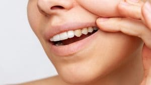 Macchie, patina gialla e sanguinamento: cosa dicono i denti della nostra salute