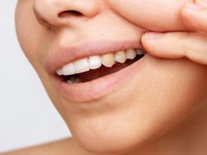 Macchie, patina gialla e sanguinamento, la dentista Polizzi rivela cosa dicono i denti della nostra salute