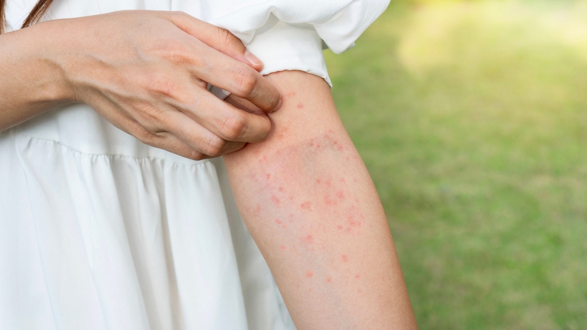 Allergia al sole, come distinguerla da altri sfoghi, il dermatologo: "Compare con chiazze o vescicole pruriginose"