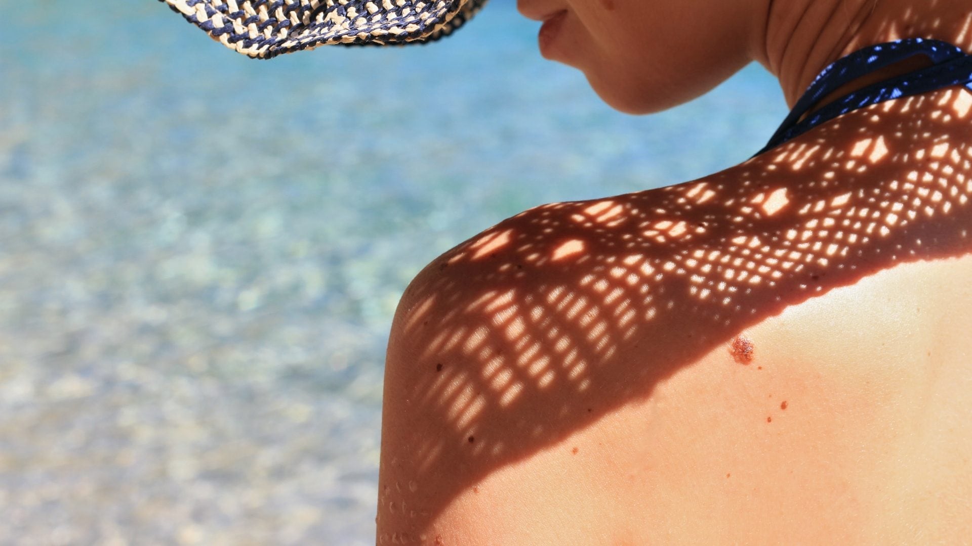 "Mai condividere asciugamani”, il dermatologo Mercuri spiega come prevenire sfoghi sulla pelle in estate