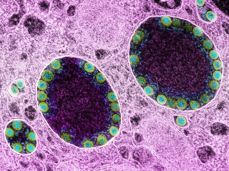 Le conseguenze del Covid si ripercuotono su cervello e memoria anche a distanza di un anno