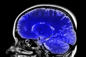Danni al cervello a lungo termine nei pazienti Covid: rischio elevato di ictus e problemi di memoria