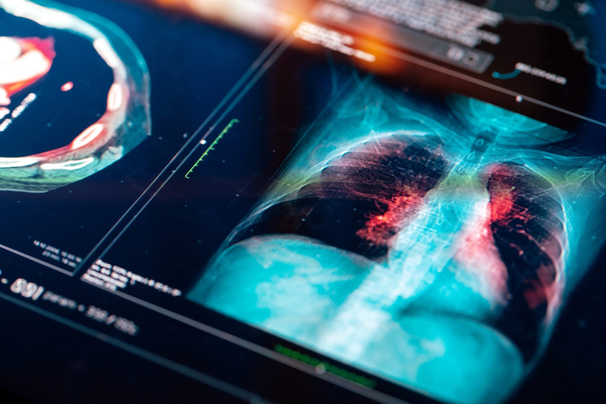 Una nuova terapia combinata rende operabile il cancro al polmone avanzato in 3 casi su 4