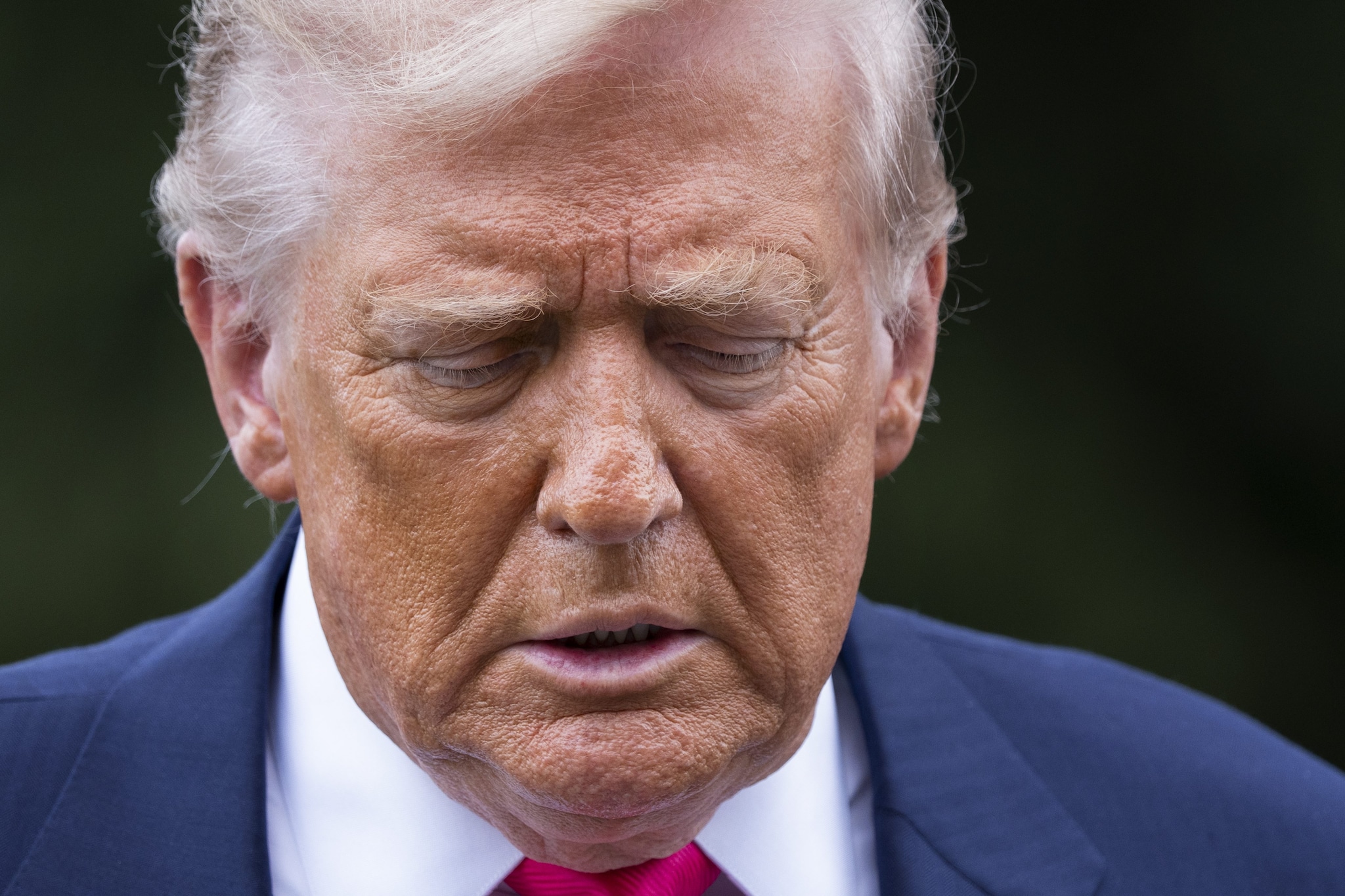 Cos'è l'insufficienza venosa cronica di cui soffre Donald Trump: sintomi, rischi e come si cura