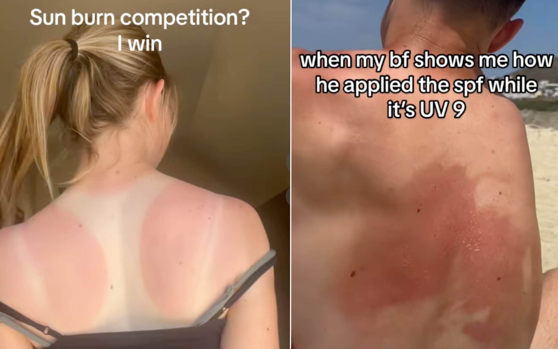 Fare a gara a chi si brucia di più: perché i video della Sunburn challenge sono davvero pericolosi