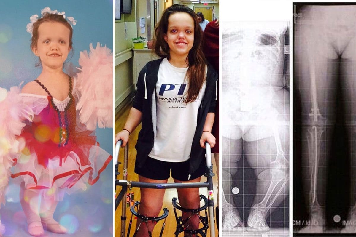 “L’intervento per crescere in altezza mi ha cambiato la vita”: la giovane con nanismo mostra il suo aspetto attuale