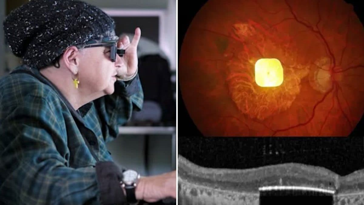 Sheila Irvine, 70 anni, è una delle persone che ha riacquistato la vista grazie a un innovativo impianto oculare. A destra, il nuovo impianto oculare posizionato sotto la retina / Credit: Science Corporation/Moorfields Eye Hospital
