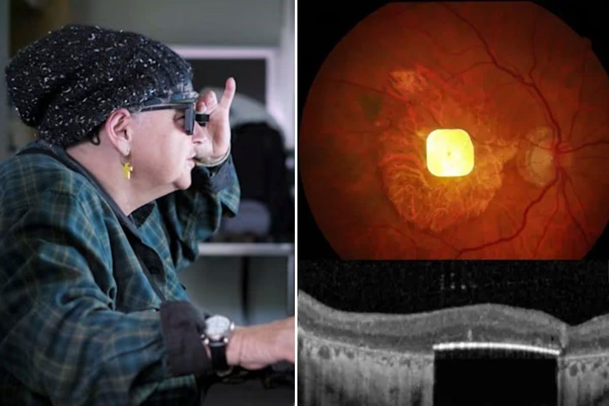 Perde la vista per una maculopatia incurabile, ma torna a vedere grazie a un nuovo impianto oculare