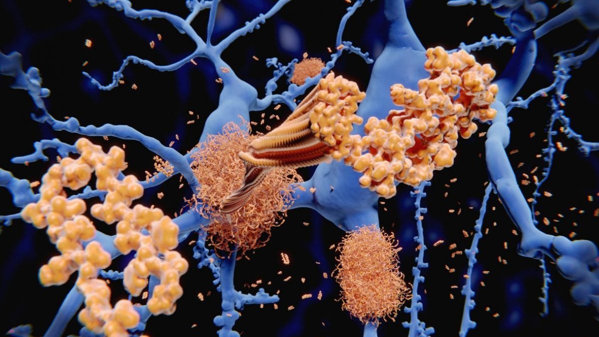 Un segnale cellulare può indurre l’aggregazione di peptidi di betamiloide (in giallo) nel cervello, accelerando la formazione di placche amiloidi tipiche dell’Alzheimer / Credit: iStock