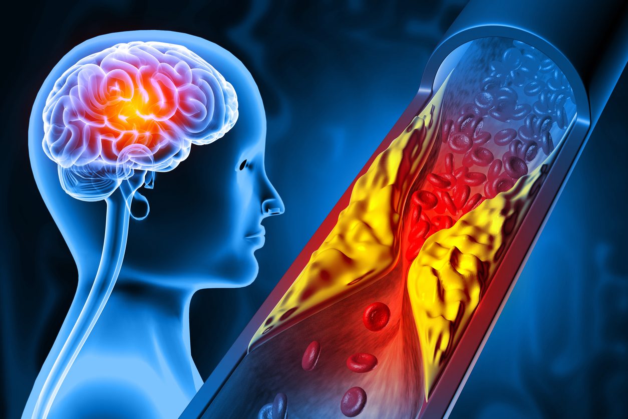 Abbassare il colesterolo fa bene al cuore e al cervello: riduce anche il rischio di demenza