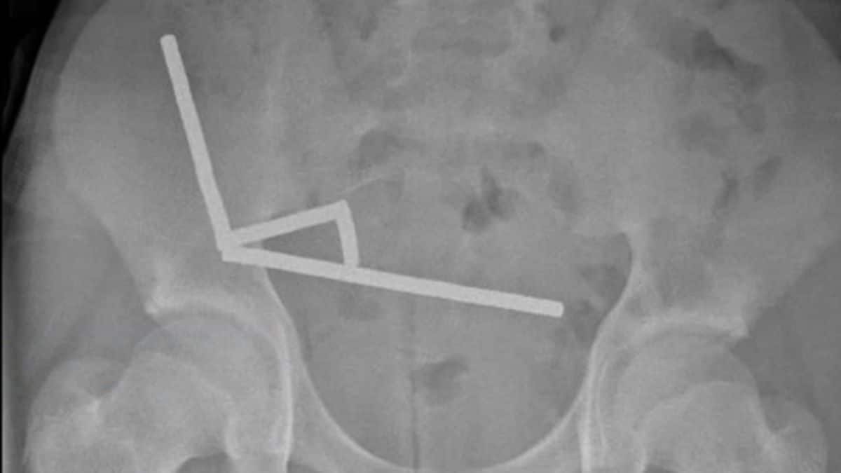 La radiografia mostra i magneti al neodimio nell’addome dell’adolescente. Credit: Lekamalage et al. / NZMJ