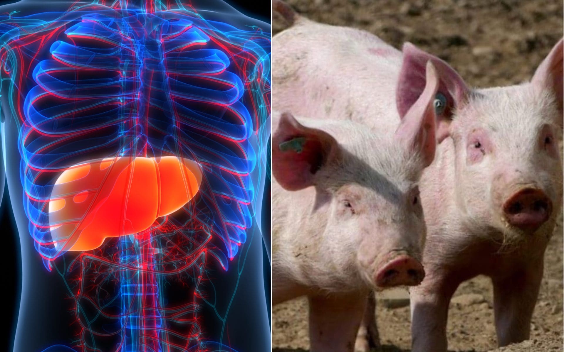 Come è finito il primo trapianto di fegato di maiale in un uomo vivo