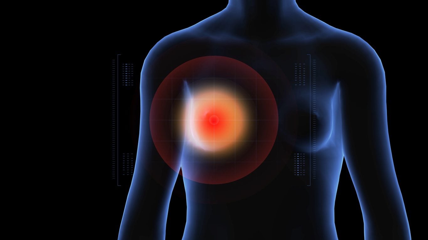 Il tipo di tumore al seno i cui casi aumentano più di tutti: è anche il più difficile da individuare