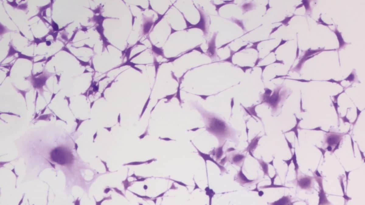 Le cellule del glioblastoma bloccate dall’idralazina, un comune farmaco contro l’ipertensione. Credit: Kyosuke Shishikura