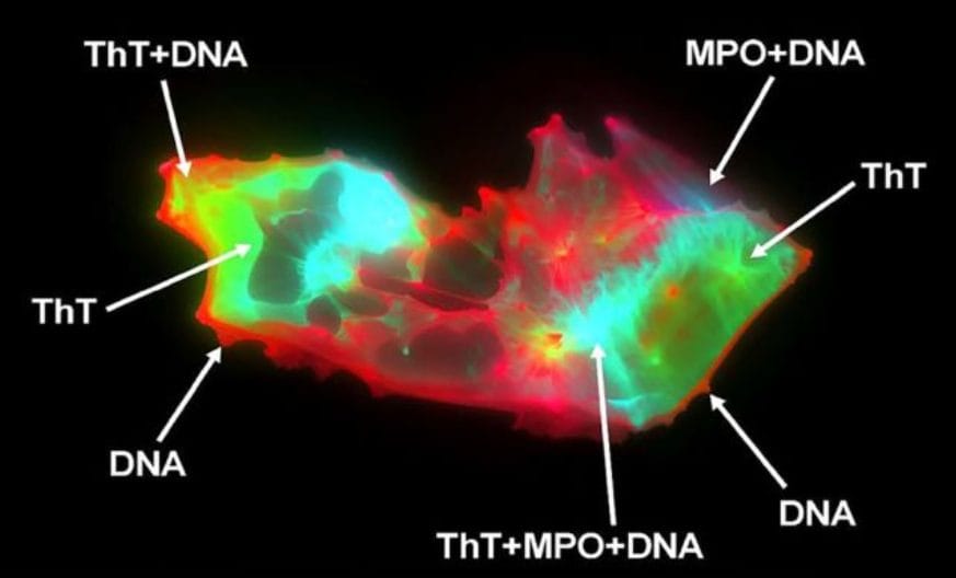 Livelli elevati di strutture anomale scoperte nel sangue dei pazienti con Covid Lungo