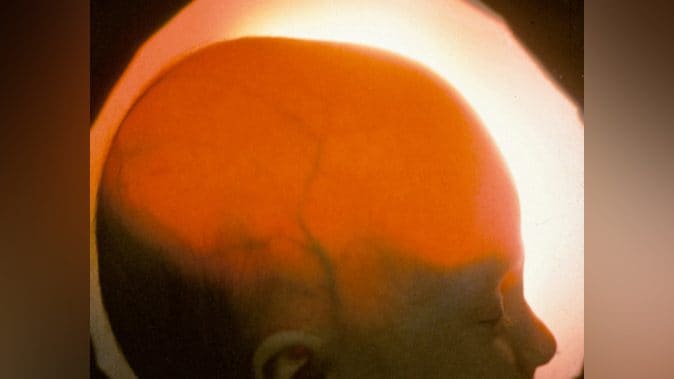 Alex, una ragazza nata senza gran parte del cervello, ha appena compiuto 20 anni: com'è possibile