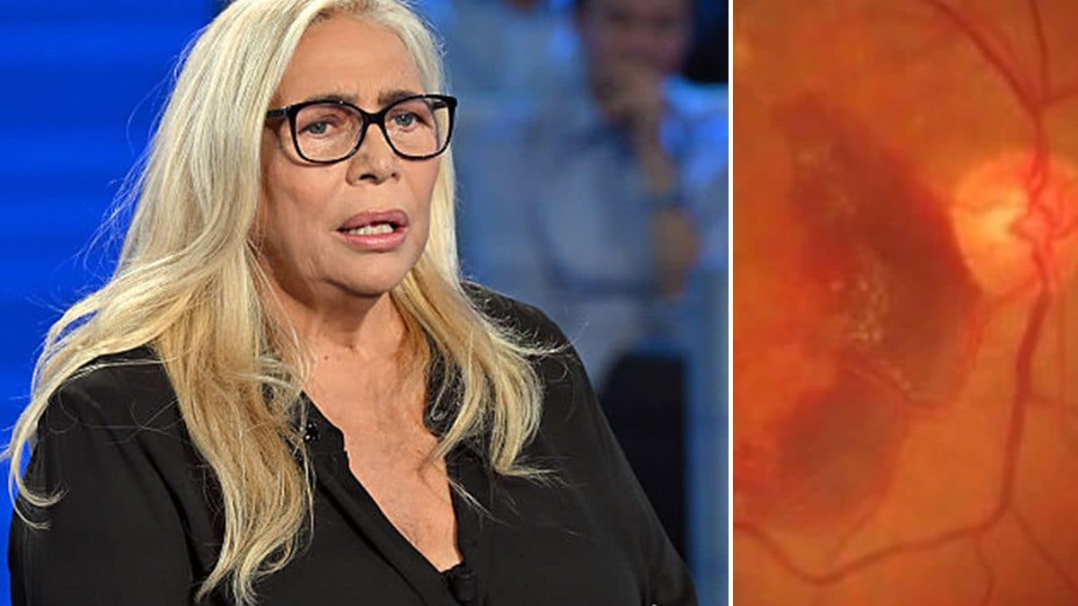 Mara Venier, 75 anni, ha raccontato di soffrire di maculopatia essudativa, una grave forma di degenerazione maculare legata all’età / Photo: Getty