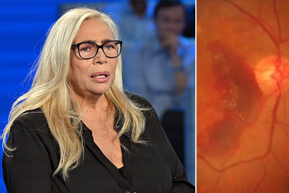 Cos’è la maculopatia e quali sono i sintomi: il caso di Mara Venier e l’intervento