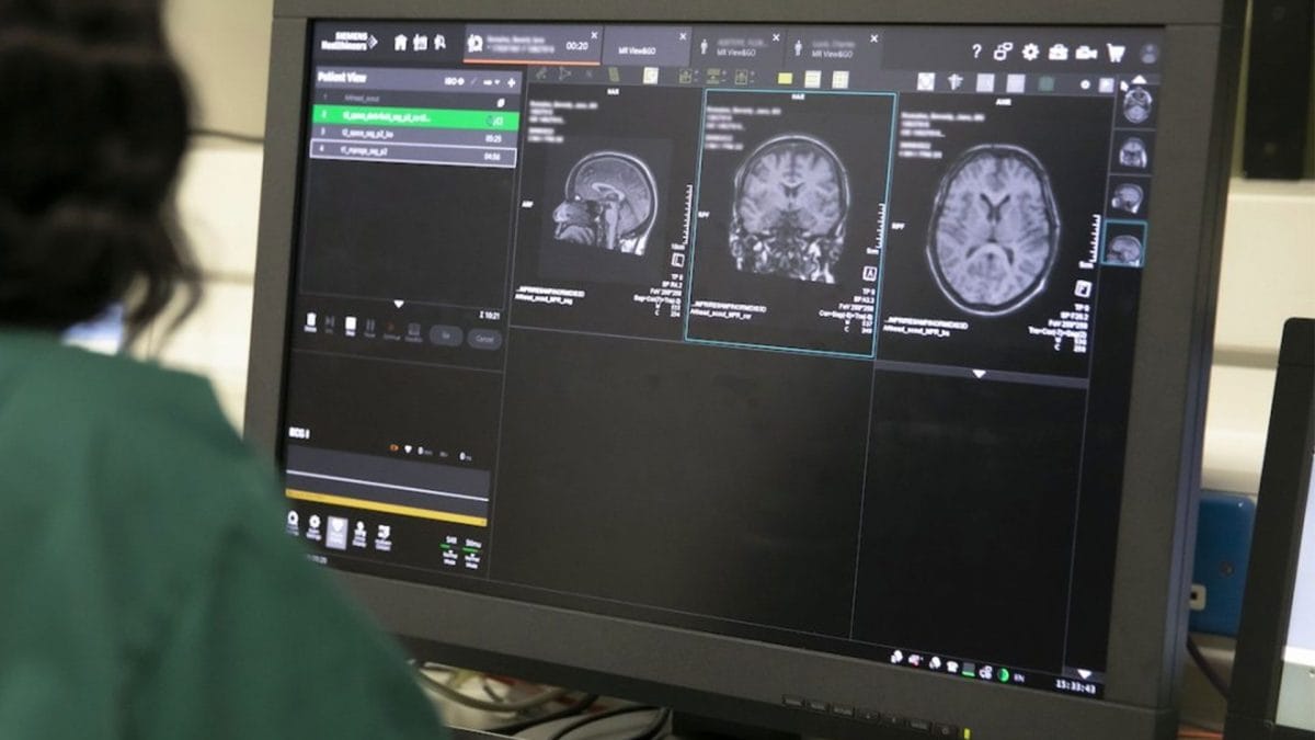 Immagini di risonanza magnetica cerebrale analizzate con strumenti di intelligenza artificiale nello studio pubblicato su Brain / Credit: MS Society