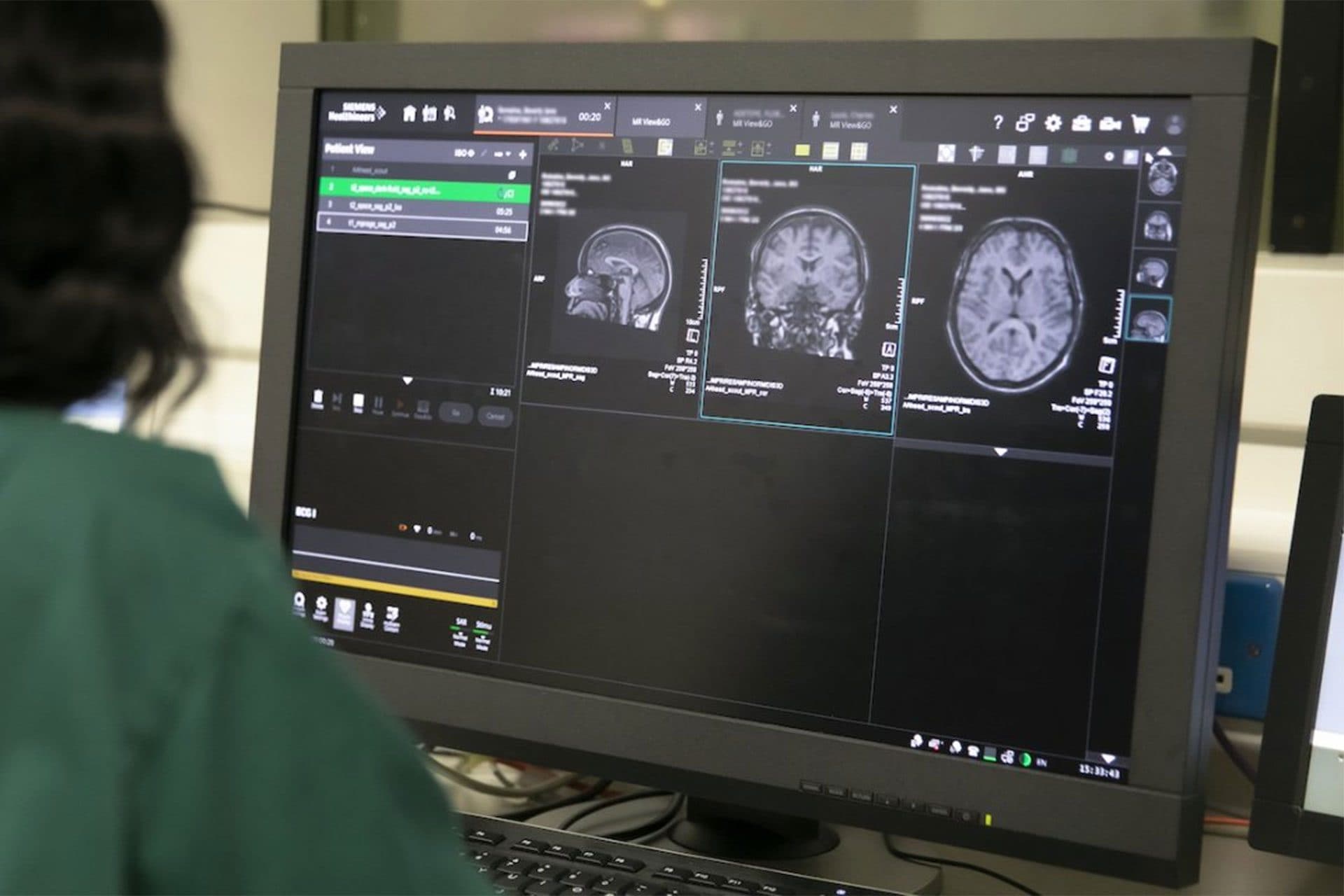 Due nuovi sottotipi di sclerosi multipla identificati con l’intelligenza artificiale