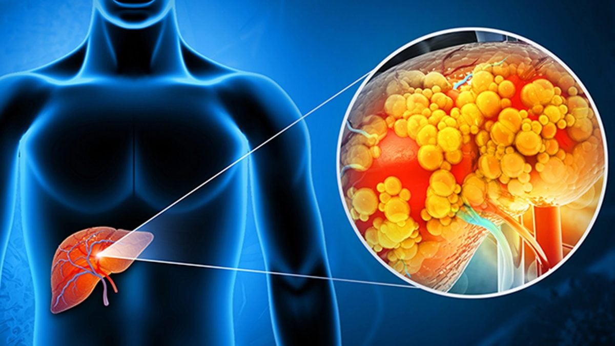 Cambiamenti nelle cellule del fegato dovuti a un’esposizione prolungata a regimi alimentari ad alto contenuto di grassi, come la dieta chetogenica, possono aumentare la vulnerabilità al cancro, secondo un nuovo studio del MIT. Photo: iStock