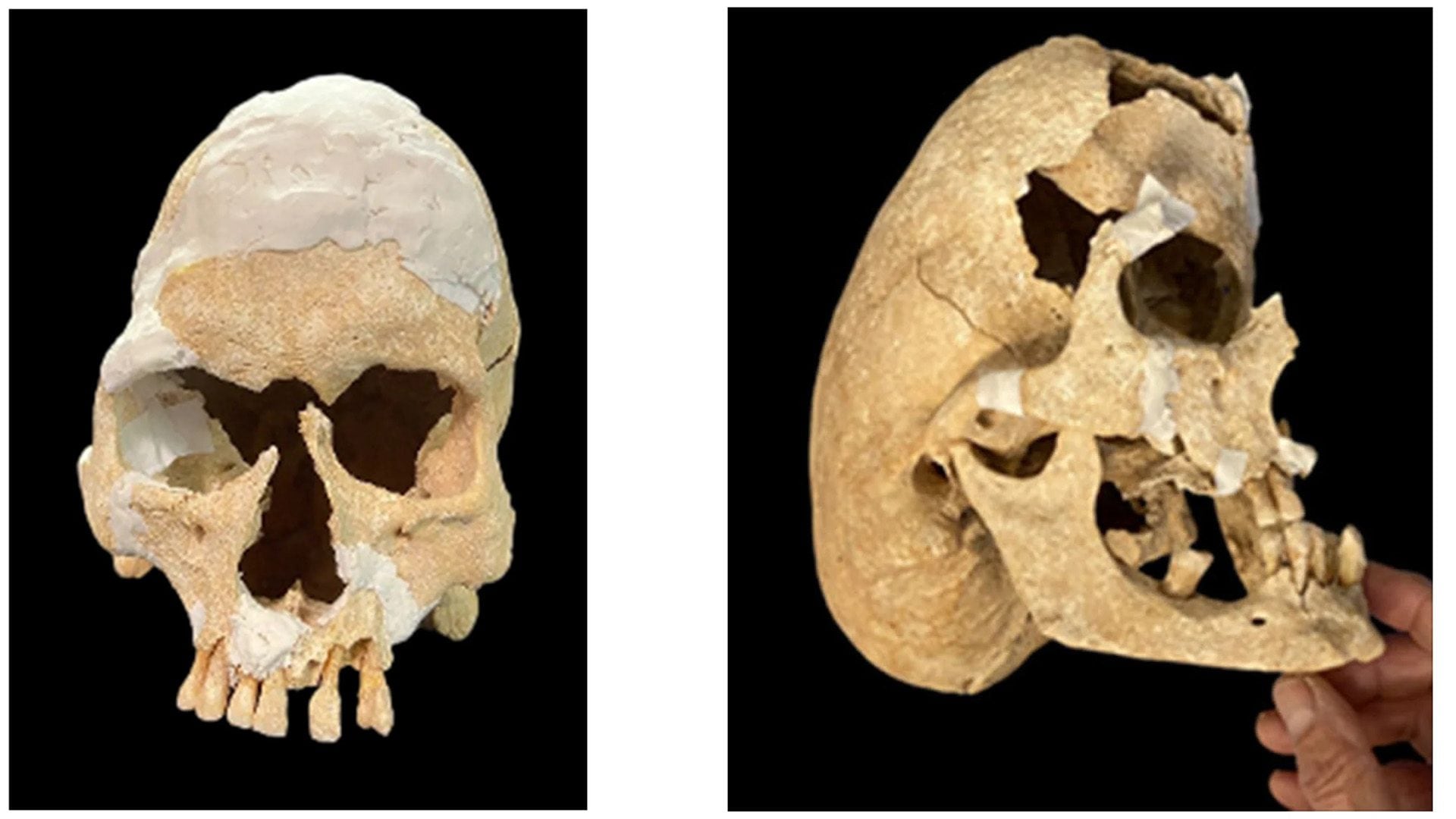 Un cavaliere medievale morto in battaglia era affetto da una rara sindrome: la scoperta degli archeologi